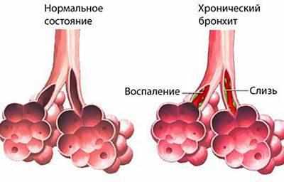 Хронический бронхит