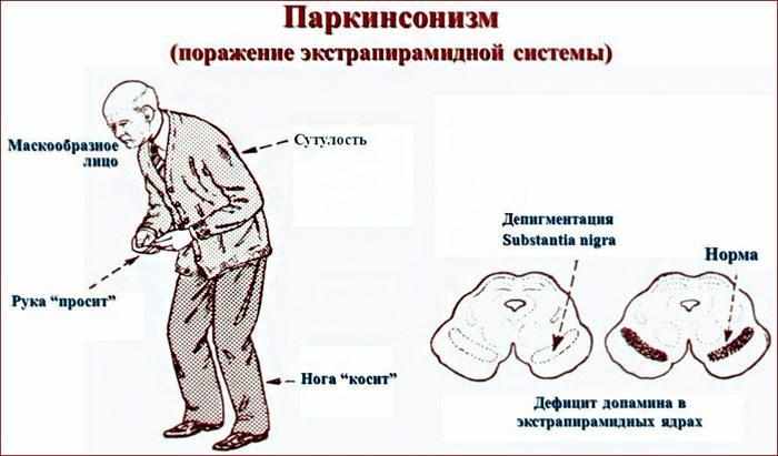 симптомы болезни Паркинсона