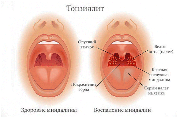 симптомы тонзиллита
