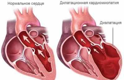 Проявление кардиосклероза