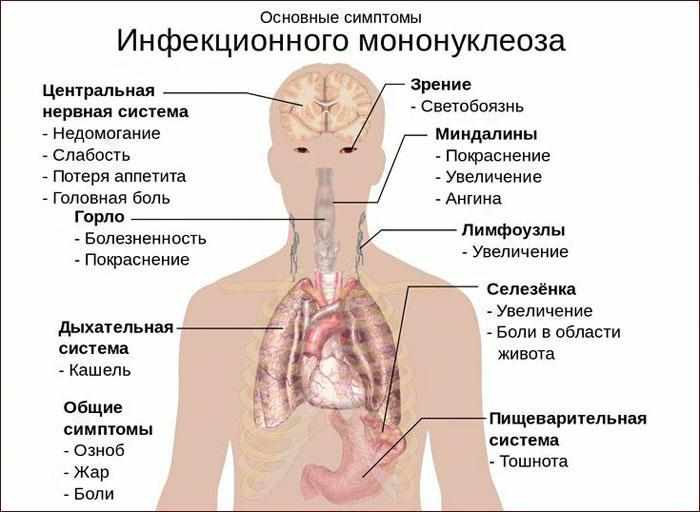 Симптомы мононуклеоза
