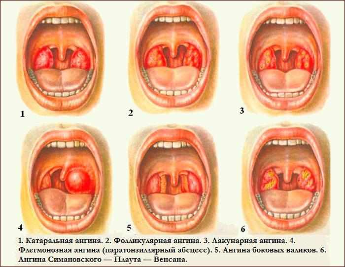 Виды ангины
