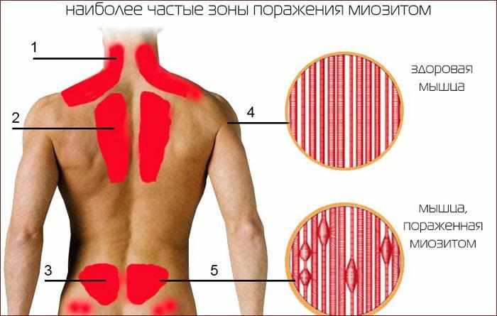 основные очаги миозита