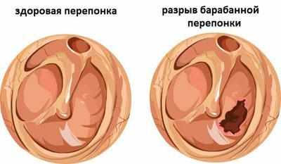 Разрыв барабанной перепонки