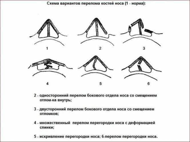Типы переломов носа