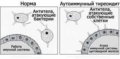 Суть тиреоидита