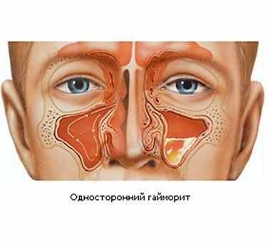 Гайморит