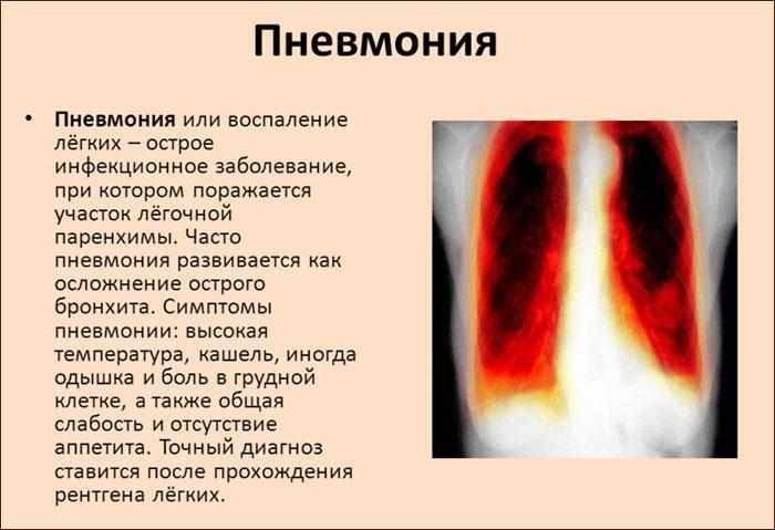 Симптомы пневмонии