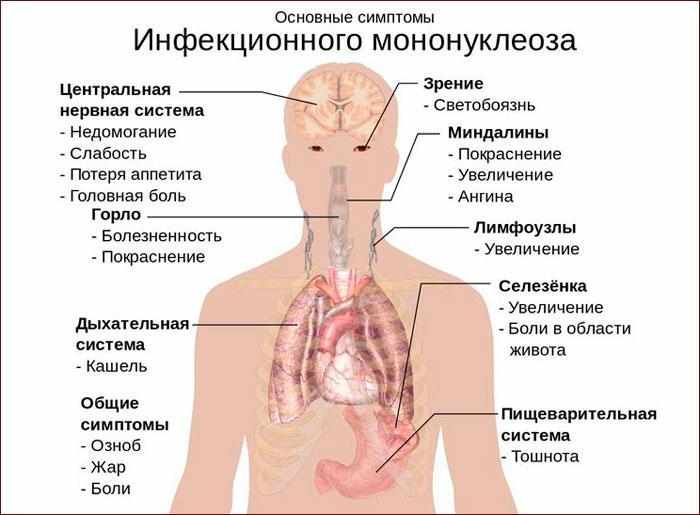 симптомы мононуклеоза