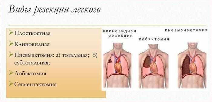 виды резекции легкого