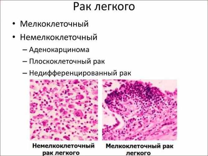 Виды рака лёгких