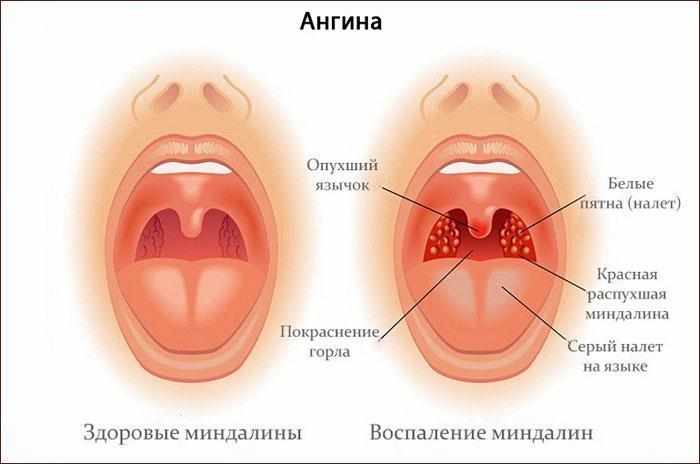 Симптомы ангины