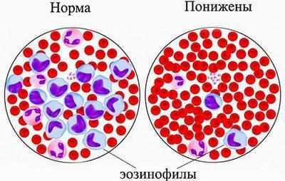 Пониженные эозинофилы