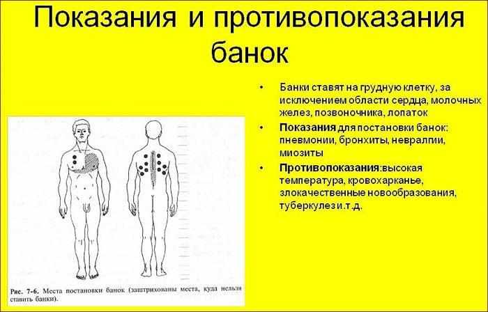 Показания и противопоказания банок