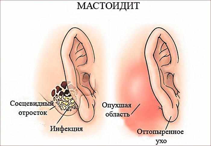 признаки мастоидита