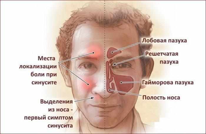 Проявление синусита