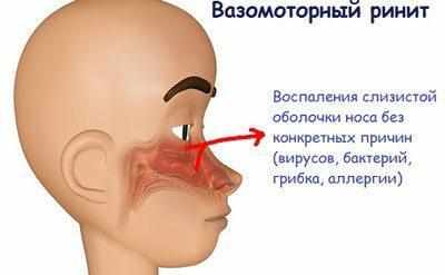 Вазомоторный ринит