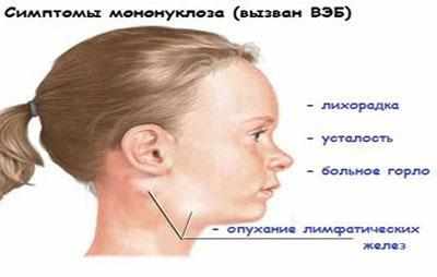 Симптомы мононуклеоза