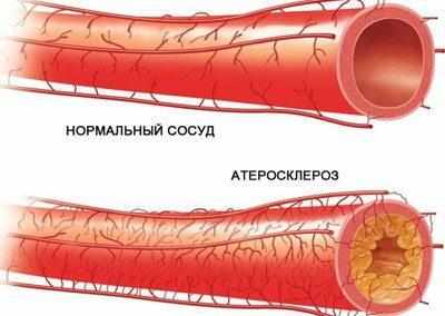 Сосуд при атеросклерозе