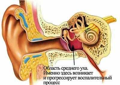 Воспаление среднего уха