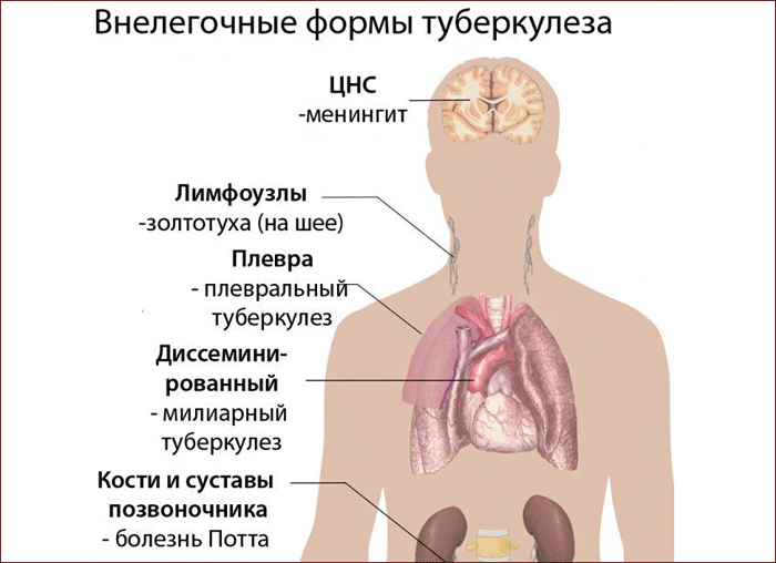 Внелегочная форма туберкулеза