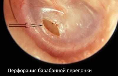 Перфорация барабанной перепонки