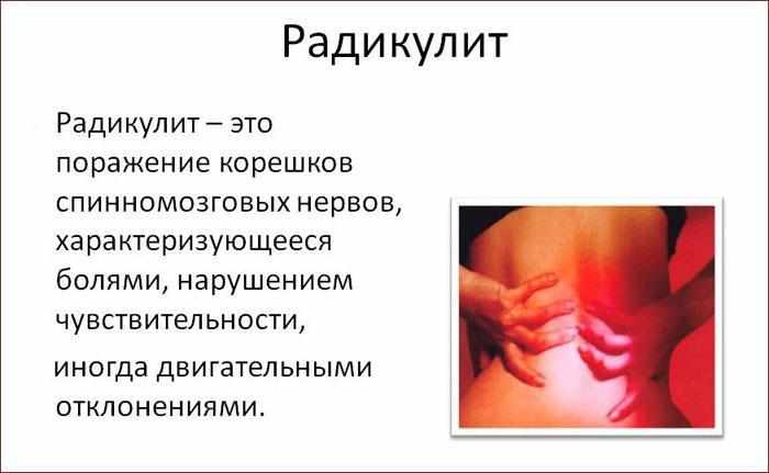 Симптомы радикулита