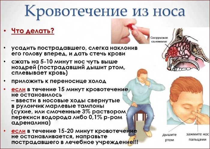 как остановить носовое кровотечение