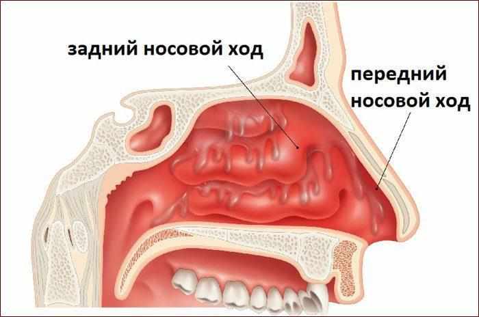 Заложенность носа