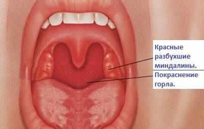 Вирусная ангина