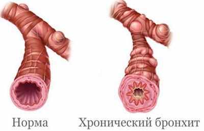 Хронический бронхит