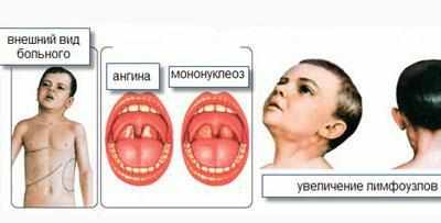 Признаки инфекционного мононуклеоза