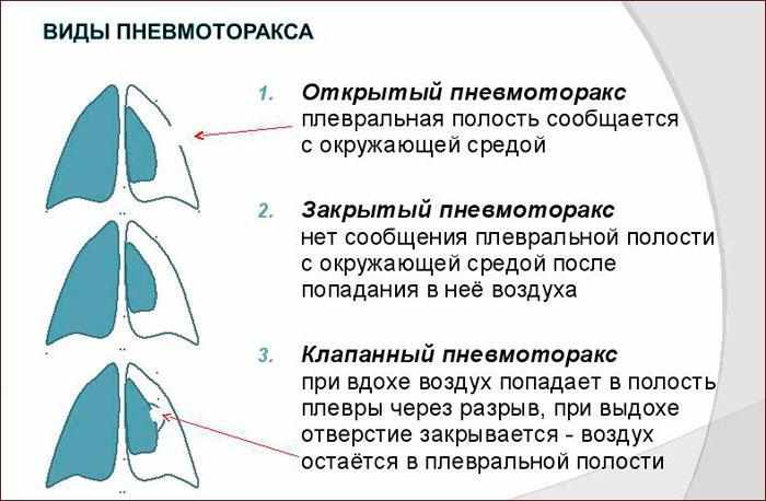 Виды пневмоторакса
