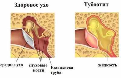 Проявление тубоотита