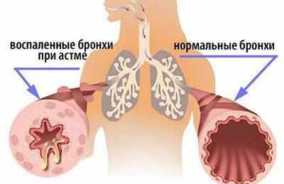 Бронхи при астме