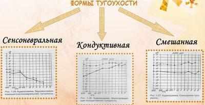Формы тугоухости