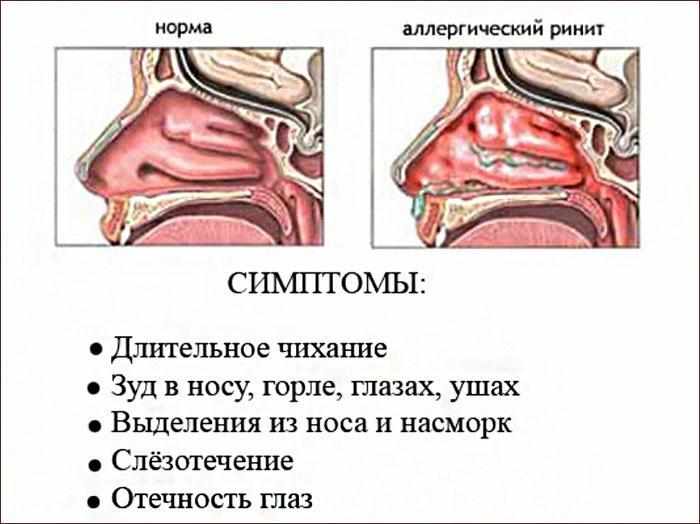 Симптомы аллергического ринита