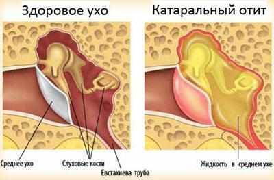 Следствие катарального отита
