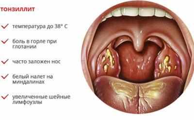 Хронический тонзиллит