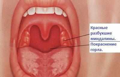 Горло при ангине