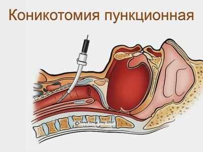Коникотомия 