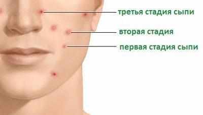 Стадии ветрянки