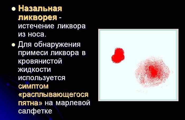 Назальная ликворея.