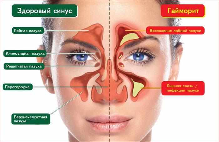 симптомы при гайморите