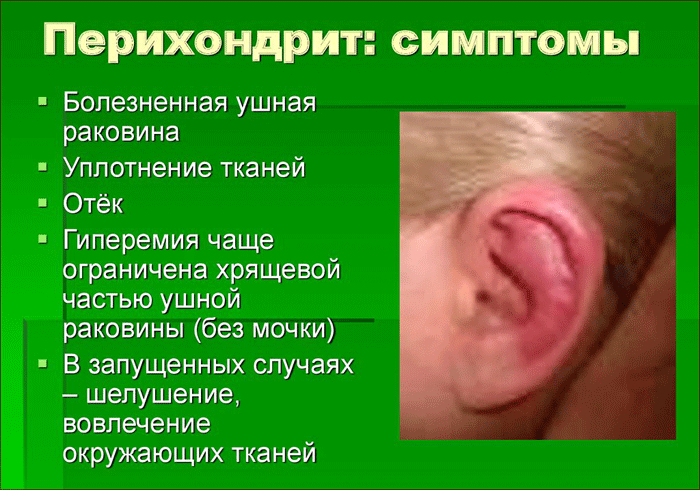 Симптомы перихондрита