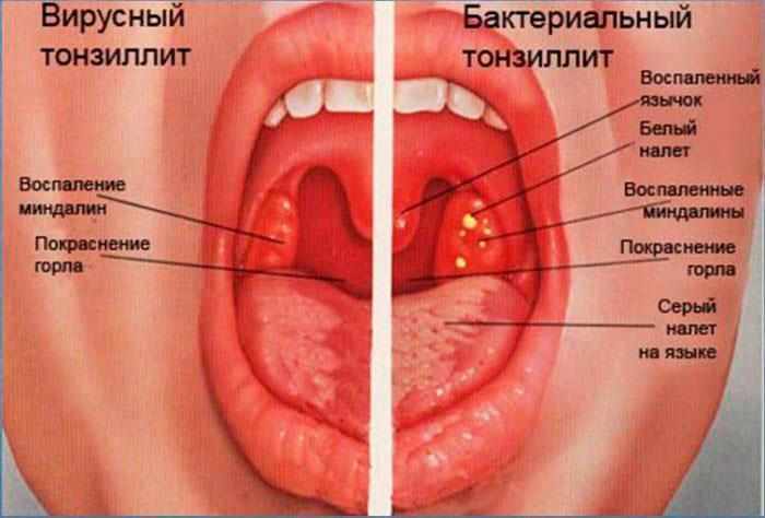 симптомы тонзиллита