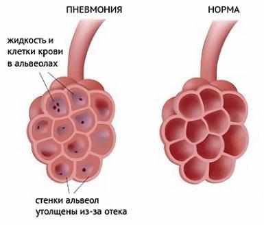 Здоровые альвеолы