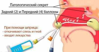 Введение в носовую полость ямик катетера
