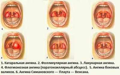 Виды ангины