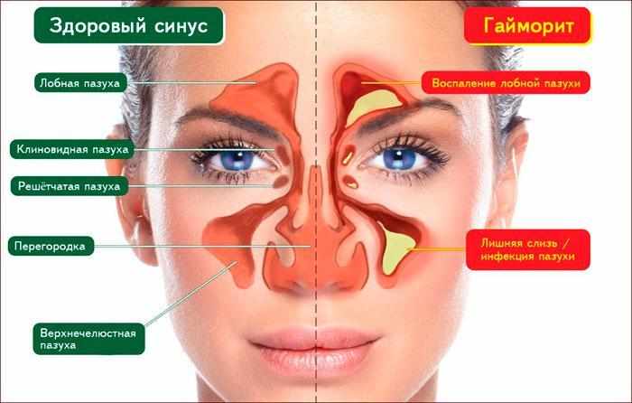 Признаки гайморита